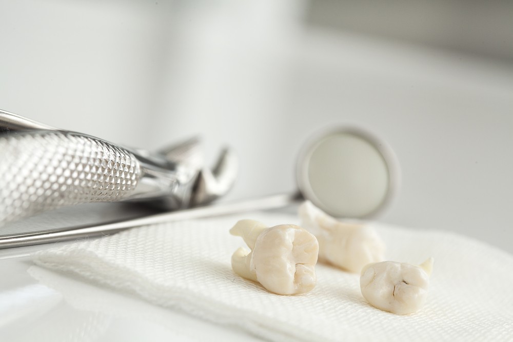 Wisdom teeth facts chattanooga periodontics dental implants