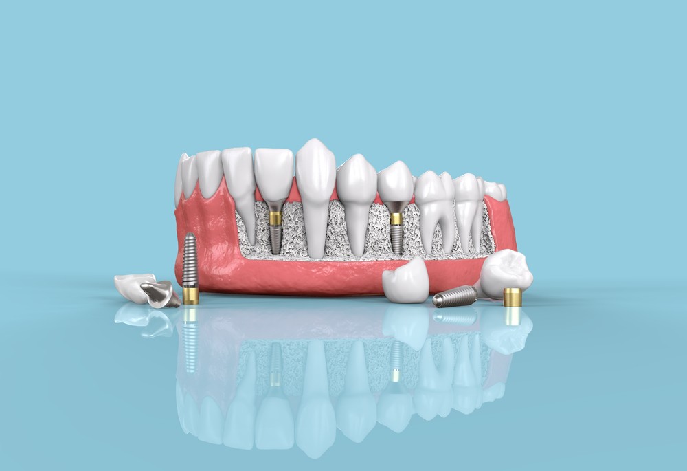 Dental implants chattanooga periodontics dental implants